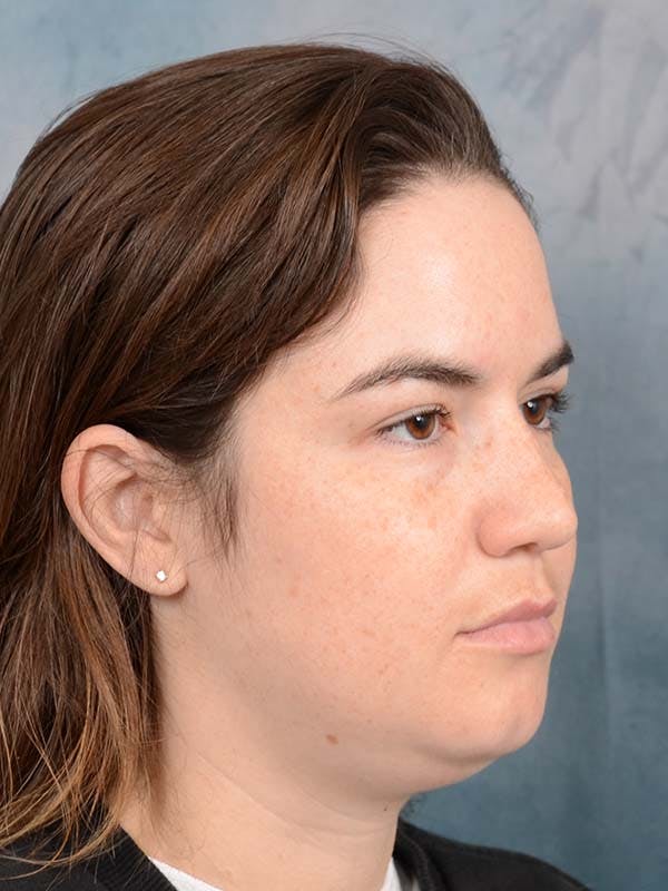 Deep Neck Lift Before & After Gallery - Patient 121744758 - Image 7