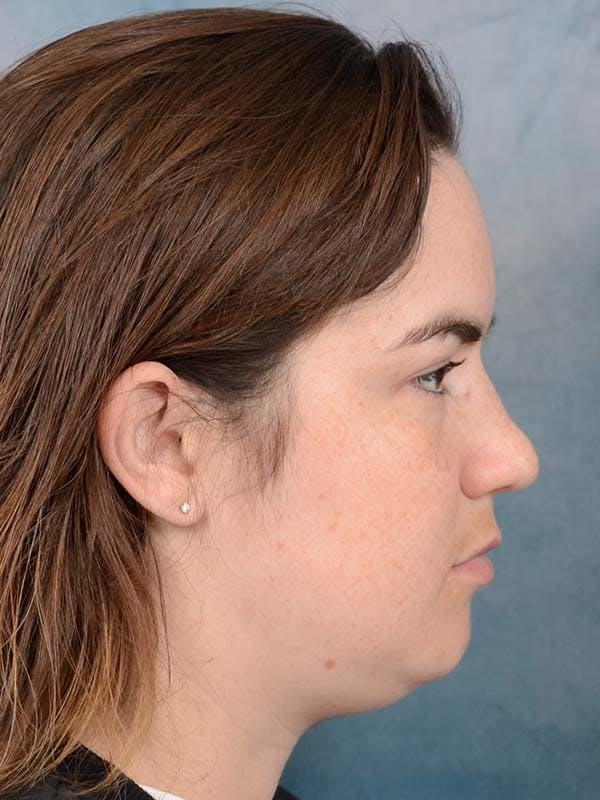 Deep Neck Lift Before & After Gallery - Patient 121744758 - Image 9