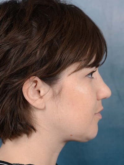 Deep Neck Lift Before & After Gallery - Patient 121744758 - Image 10