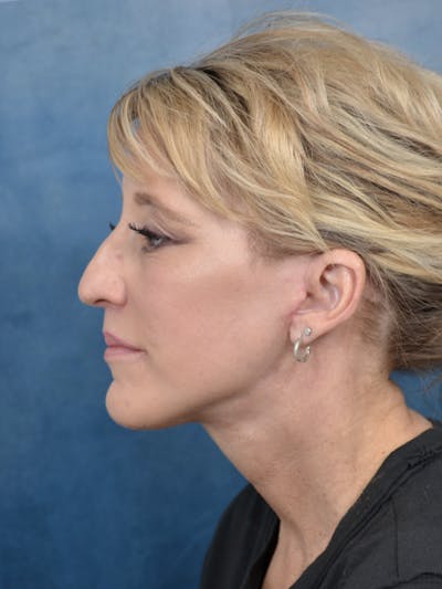 Deep Plane Facelift Before & After Gallery - Patient 121869351 - Image 4