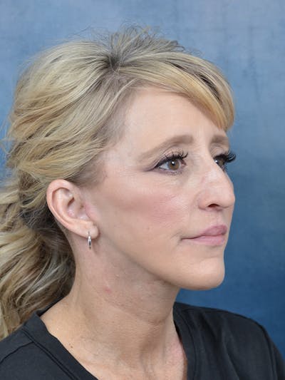 Deep Plane Facelift Before & After Gallery - Patient 121869351 - Image 8