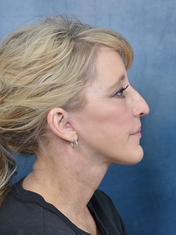 Deep Plane Facelift Before & After Gallery - Patient 121869351 - Image 10