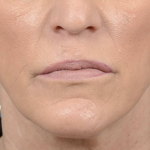 Lip Lift Before & After Gallery - Patient 121869405 - Image 1