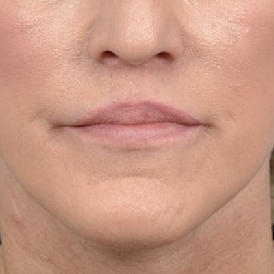 Lip Lift Before & After Gallery - Patient 121869405 - Image 2
