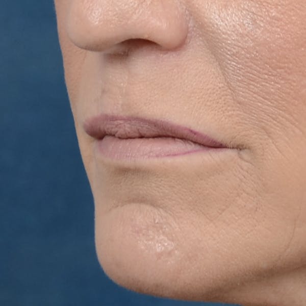 Lip Lift Before & After Gallery - Patient 121869405 - Image 3