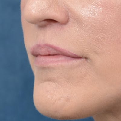 Lip Lift Before & After Gallery - Patient 121869405 - Image 4