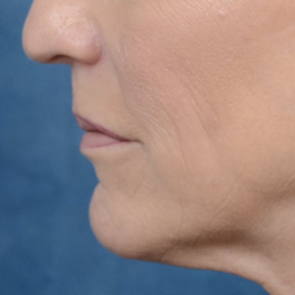 Lip Lift Before & After Gallery - Patient 121869405 - Image 5