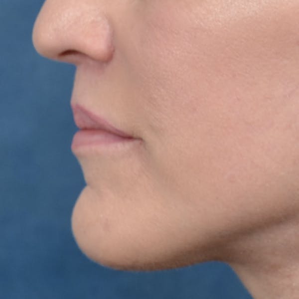 Lip Lift Before & After Gallery - Patient 121869405 - Image 6