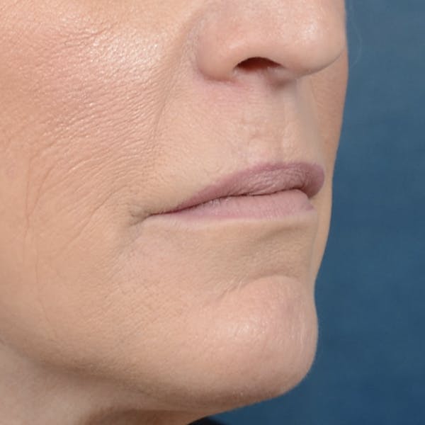 Lip Lift Before & After Gallery - Patient 121869405 - Image 7