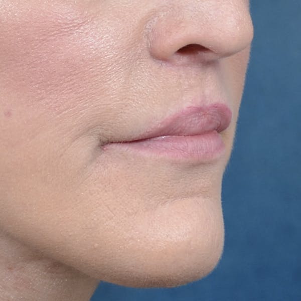 Lip Lift Before & After Gallery - Patient 121869405 - Image 8