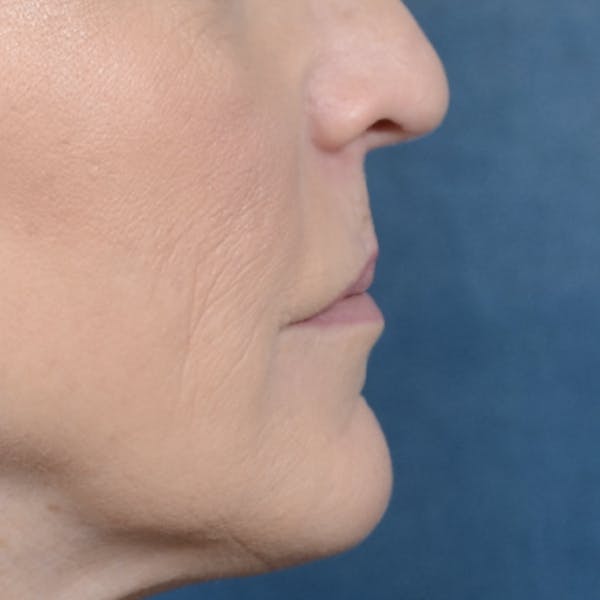 Lip Lift Before & After Gallery - Patient 121869405 - Image 9