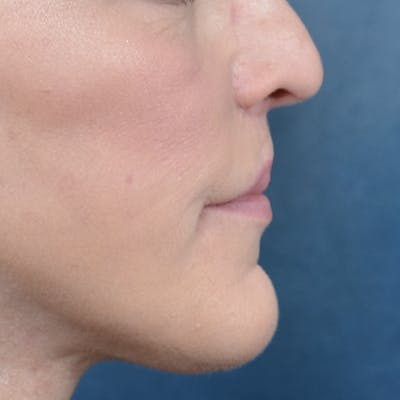 Lip Lift Before & After Gallery - Patient 121869405 - Image 10