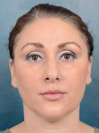 Eyelid Lift Before & After Gallery - Patient 121871729 - Image 1