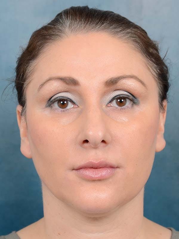 Rhinoplasty Before & After Gallery - Patient 121871703 - Image 3