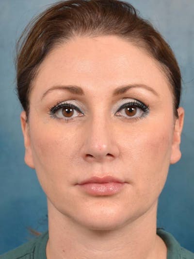 Eyelid Lift Before & After Gallery - Patient 121871729 - Image 2