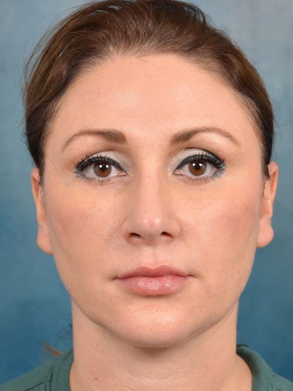 Rhinoplasty Before & After Gallery - Patient 121871703 - Image 4