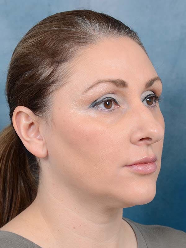 Eyelid Lift Before & After Gallery - Patient 121871729 - Image 3