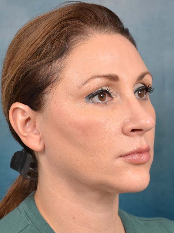 Eyelid Lift Before & After Gallery - Patient 121871729 - Image 4
