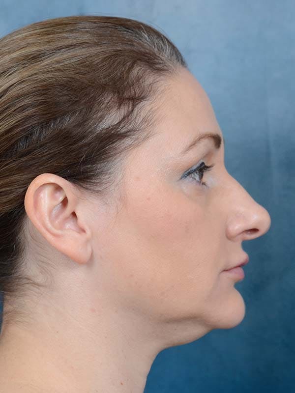 Eyelid Lift Before & After Gallery - Patient 121871729 - Image 5