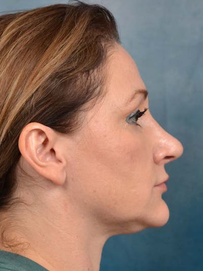 Neck Liposuction Before & After Gallery - Patient 121871727 - Image 6