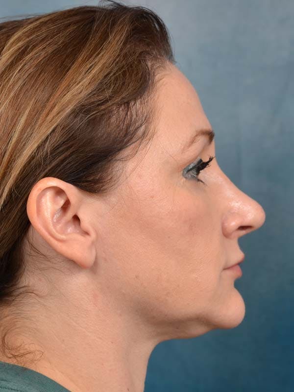 Rhinoplasty Before & After Gallery - Patient 121871703 - Image 8
