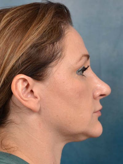 Rhinoplasty Before & After Gallery - Patient 121871703 - Image 8