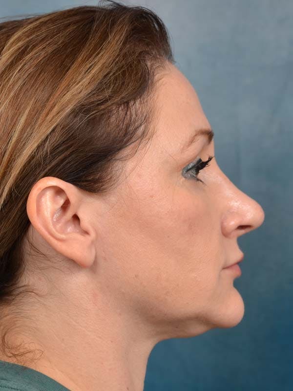 Neck Liposuction Before & After Gallery - Patient 121871727 - Image 6