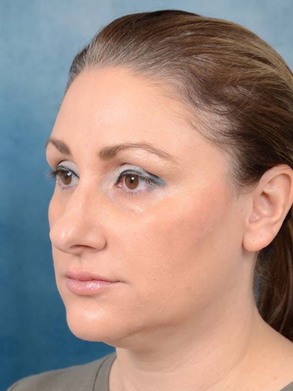 Rhinoplasty Before & After Gallery - Patient 121871703 - Image 9