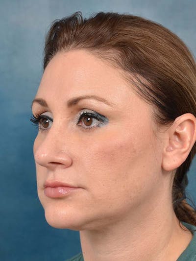 Rhinoplasty Before & After Gallery - Patient 121871703 - Image 10