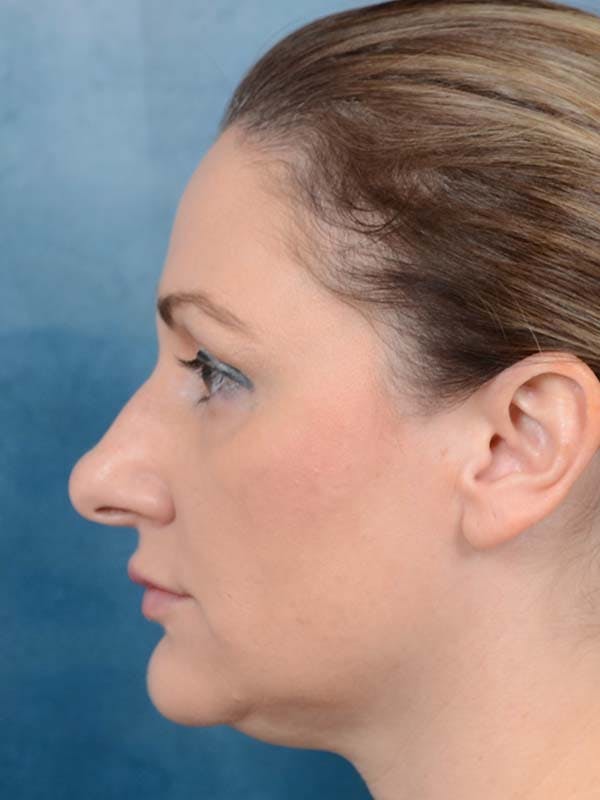 Rhinoplasty Before & After Gallery - Patient 121871703 - Image 1