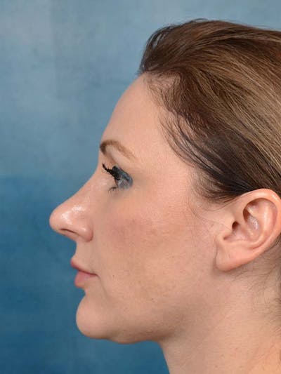 Rhinoplasty Before & After Gallery - Patient 121871703 - Image 2