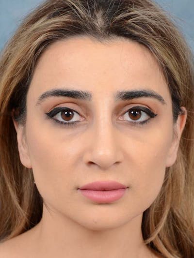 Rhinoplasty Before & After Gallery - Patient 121958483 - Image 4