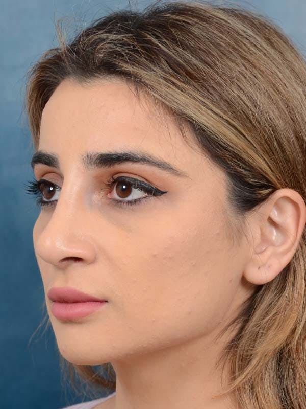 Rhinoplasty Before & After Gallery - Patient 121958483 - Image 6