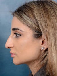 Rhinoplasty Before & After Gallery - Patient 121958483 - Image 1