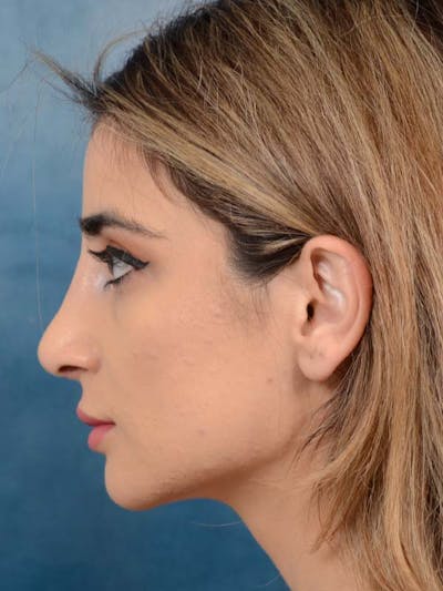 Rhinoplasty Before & After Gallery - Patient 121958483 - Image 2