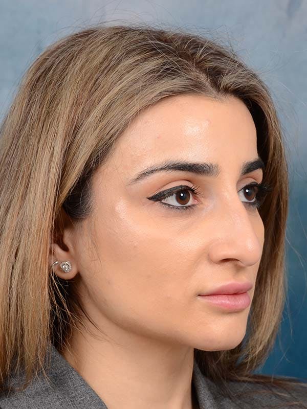 Rhinoplasty Before & After Gallery - Patient 121958483 - Image 7