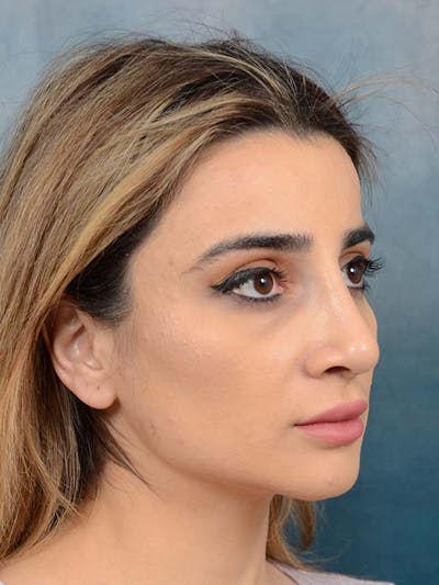 Rhinoplasty Before & After Gallery - Patient 121958483 - Image 8