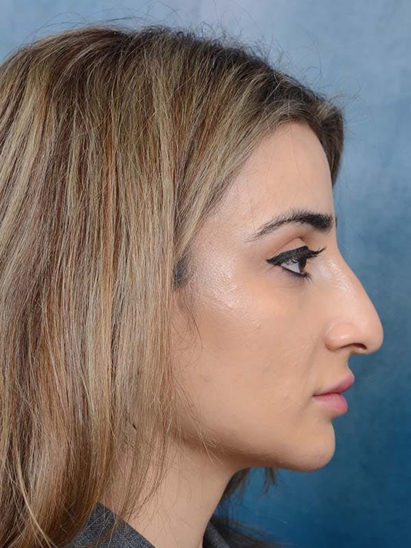 Rhinoplasty Before & After Gallery - Patient 121958483 - Image 9