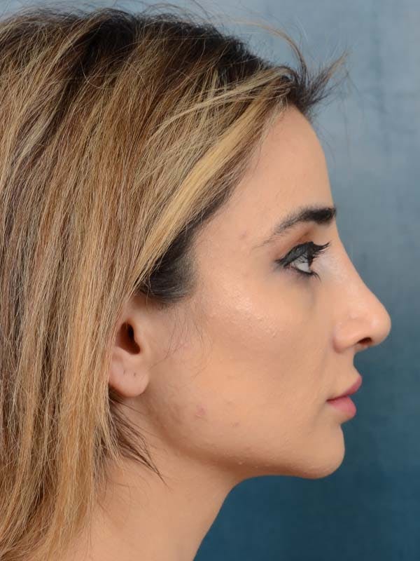 Rhinoplasty Before & After Gallery - Patient 121958483 - Image 10