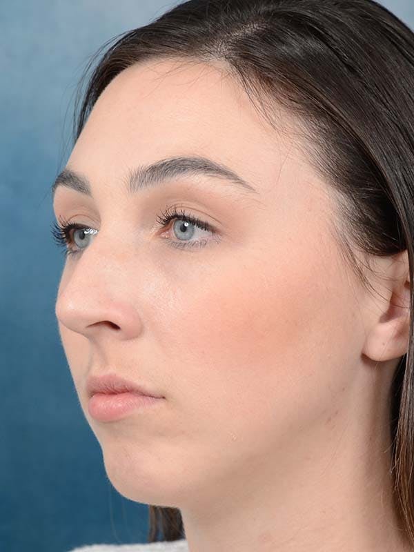 Rhinoplasty Before & After Gallery - Patient 121958588 - Image 5