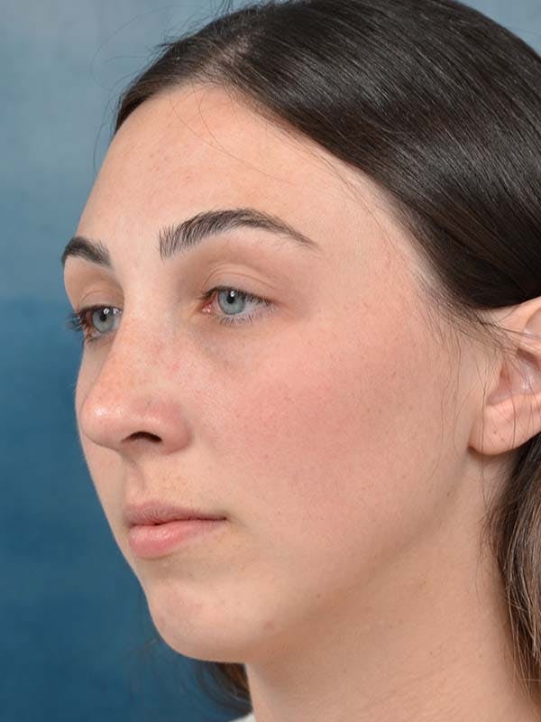 Rhinoplasty Before & After Gallery - Patient 121958588 - Image 6
