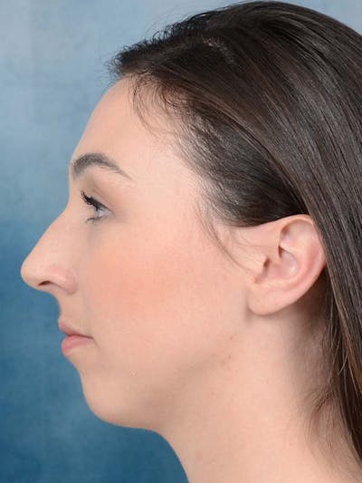 Rhinoplasty Before & After Gallery - Patient 121958588 - Image 1