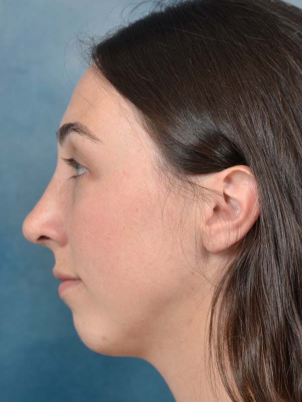 Rhinoplasty Before & After Gallery - Patient 121958588 - Image 2