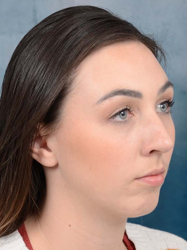 Rhinoplasty Before & After Gallery - Patient 121958588 - Image 7