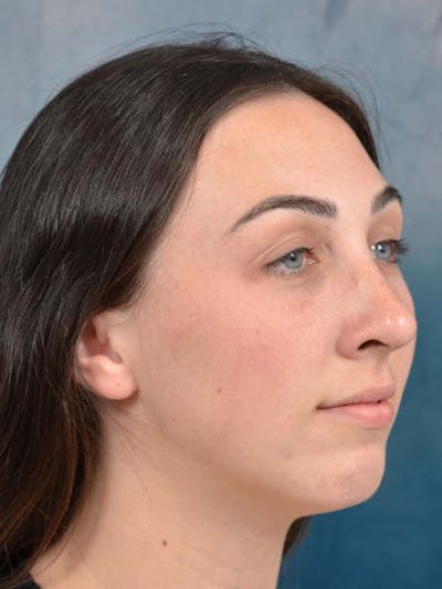 Rhinoplasty Before & After Gallery - Patient 121958588 - Image 8