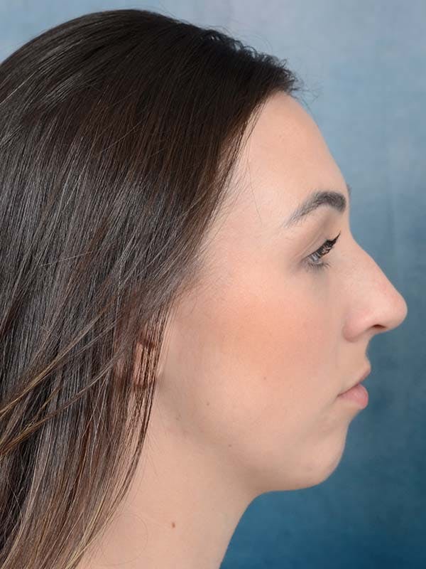 Rhinoplasty Before & After Gallery - Patient 121958588 - Image 9