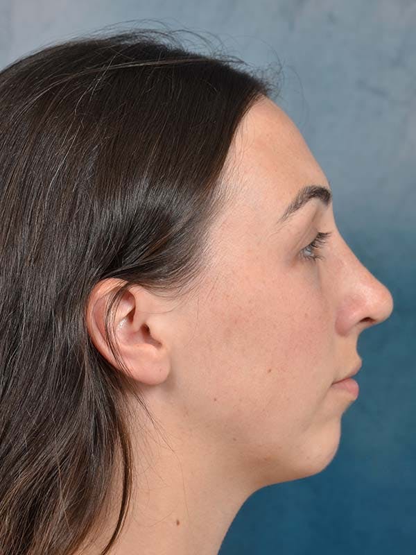 Rhinoplasty Before & After Gallery - Patient 121958588 - Image 10
