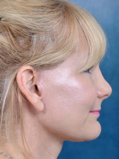 Deep Plane Facelift Before & After Gallery - Patient 121959127 - Image 8
