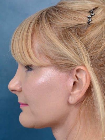 Deep Plane Facelift Before & After Gallery - Patient 121959127 - Image 10