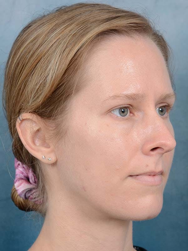 Rhinoplasty Before & After Gallery - Patient 121959740 - Image 5